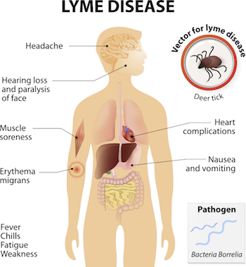 Lyme Disease And The Autism Spectrum The Autism Doctorcom - 